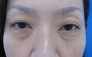 目の下のたるみ、目のくまでお悩みの方、切らずに完璧に解決します。TCB-R法　手術直後　症例写真